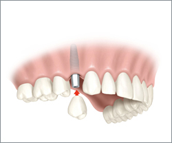 Implant dentaire Gleize
